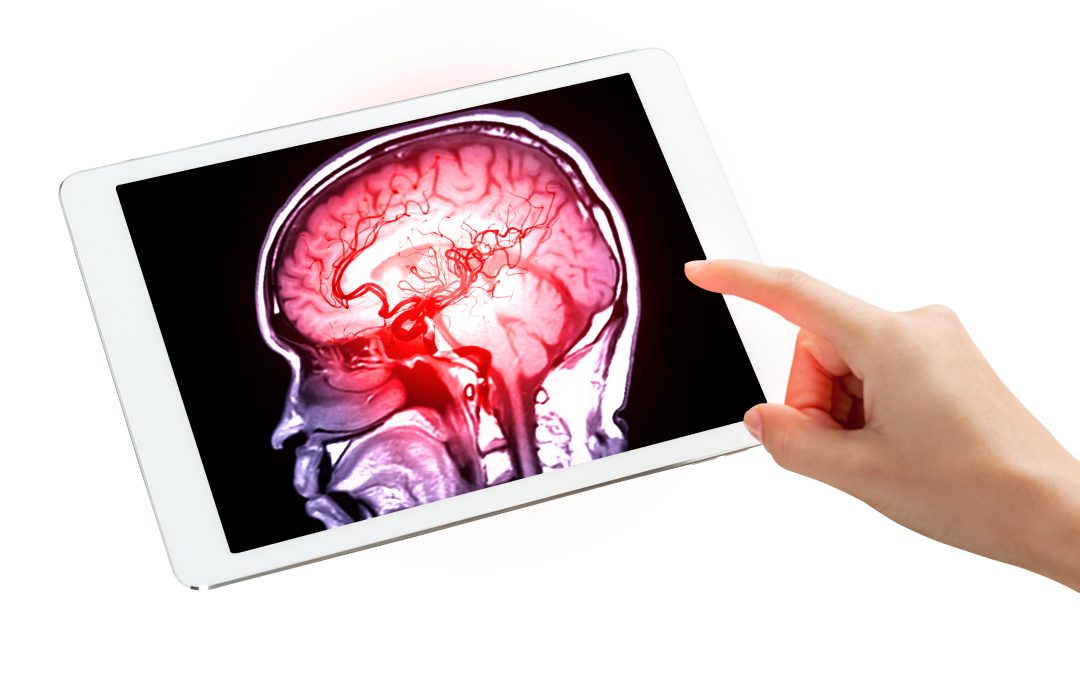 Strokes and Dementia: What You Can Do to Protect Your Brain!